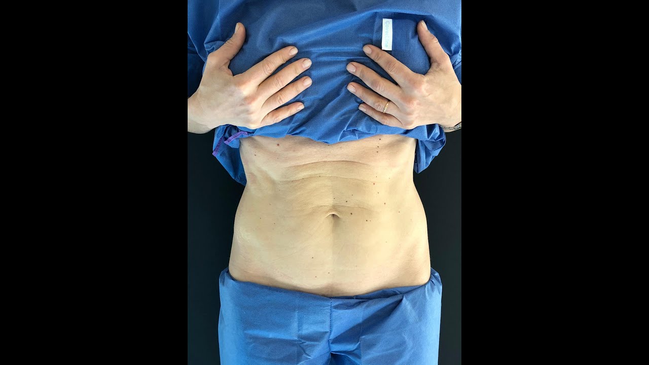 ¿Flacidez abdominal? Efecto de retracción y tensión con Hilos Tensores.