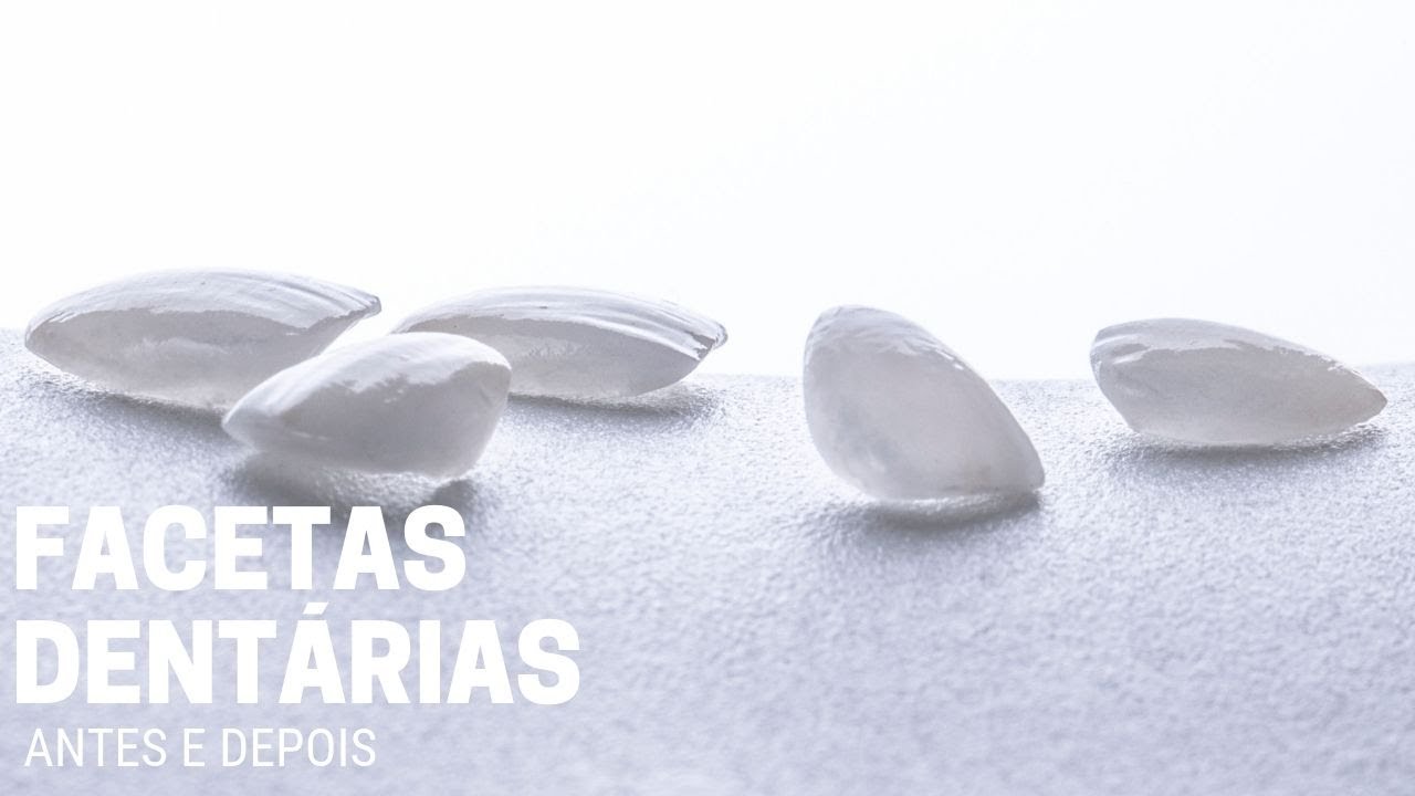 Facetas dentárias e a mudança de visual da Sónia | Clínica Hugo Madeira