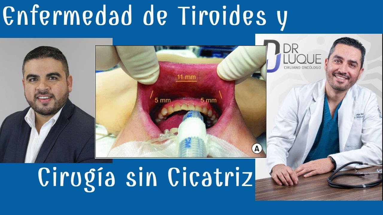 #1: ENFERMEDAD DE TIROIDES Y CIRUGÍA SIN CICATRÍZ