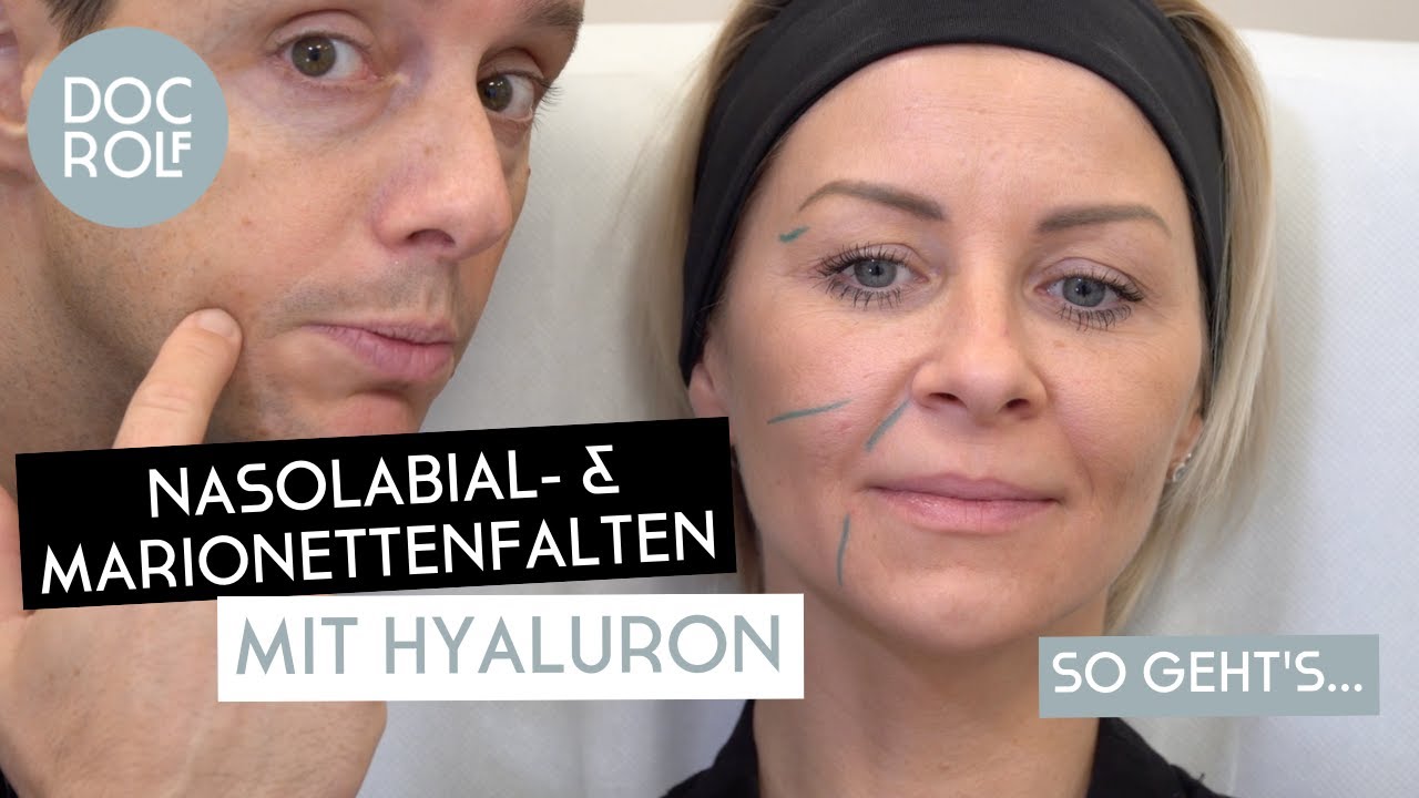 Nasolabialfalte, Marionettenfalten & Jawline mit Hyaluron SOFORT verbessern! doc.rolf