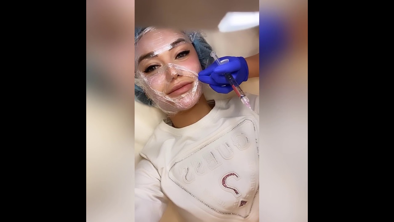 Биоревитализация Neauvia organic. Иньекции красоты .