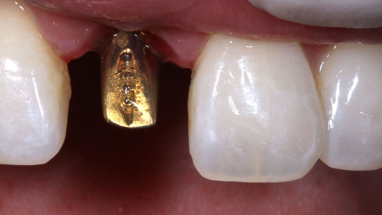 How to Get the Best Aesthetic For A Single Implant Crown