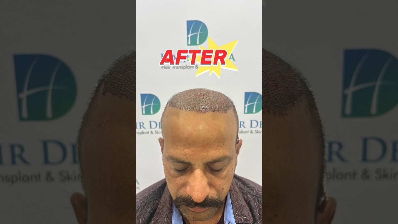 High Class Hair Implantation Before & After In Pune 