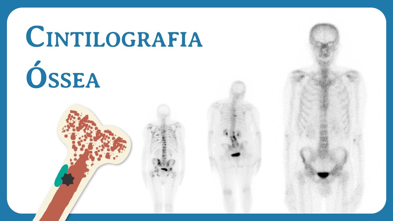 Cintilografia Óssea