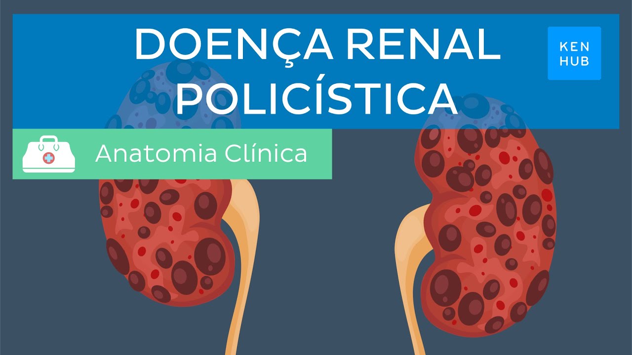 Doença renal policística: Definição, sintomas, complicações, diagnóstico e tratamento | Kenhub
