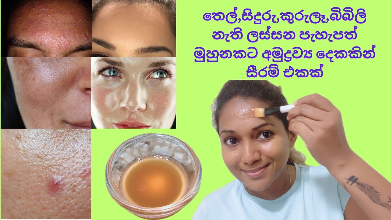මුහුනේ තෙල් වලවල් කුරුලෑ කුඩා ගැටිති නැති කරන ස්වාභාවික සත්කාරය/remove oily,poreses,pimple,tiny bum