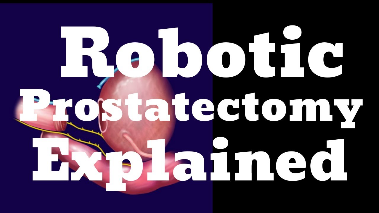 Robotic prostatectomy steps explained