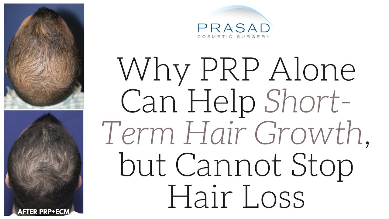 Why PRP Alone Can Help Short-Term Hair Growth, but Cannot Stop Hair Loss Progression