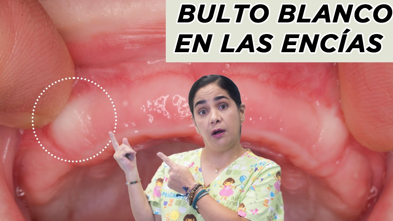 ¿Bultos blancos en las encías?