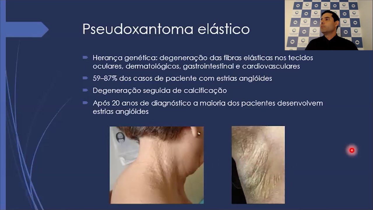 Estrias Angióides