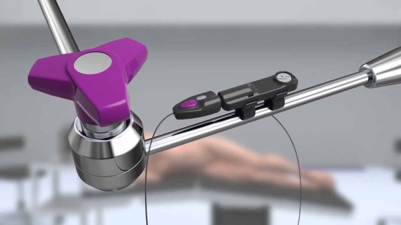 Transabdominal Muscle Action Potential (TMAP™)