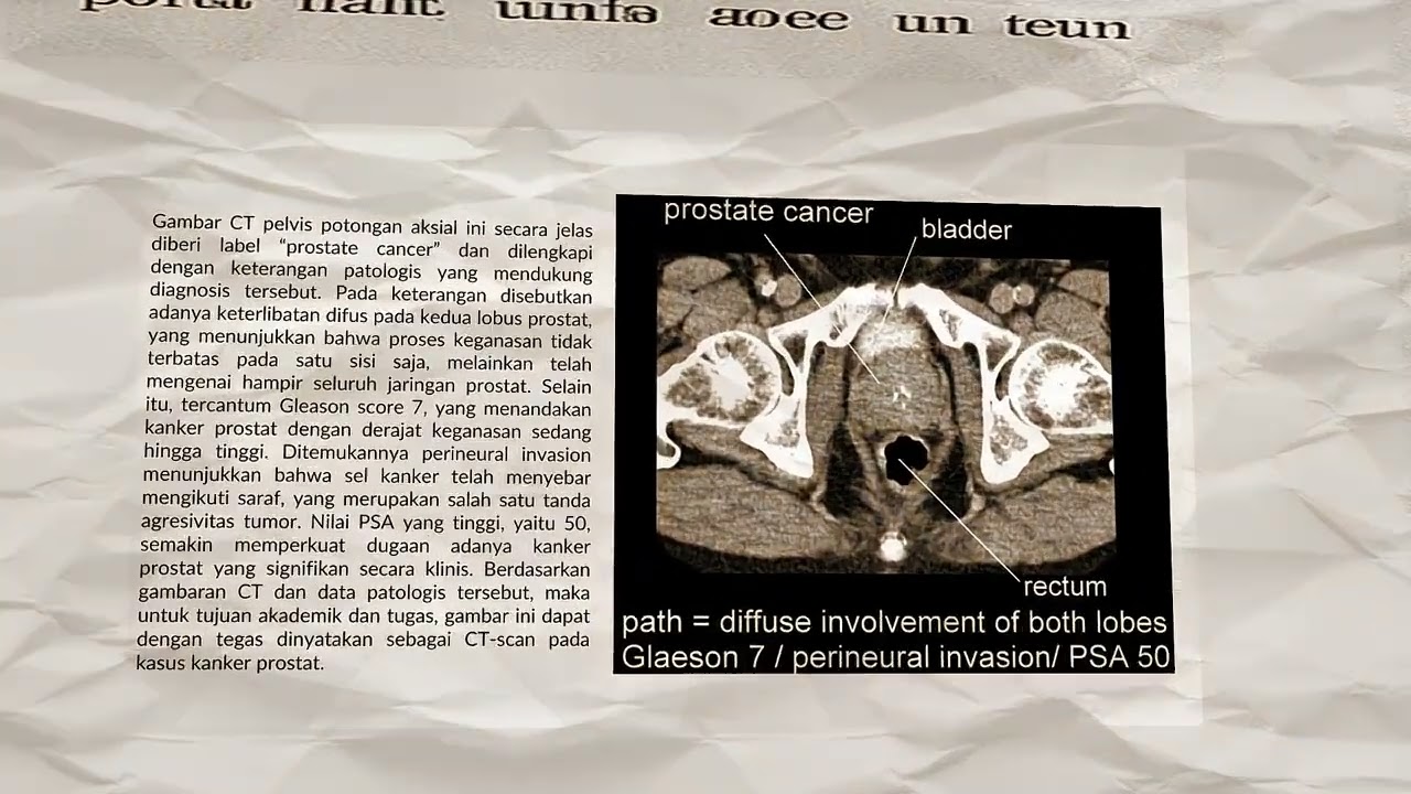 CT GENITALIA PADA KASUS KANKER PROSTAT  (M. RIFQI FAHLEFI)