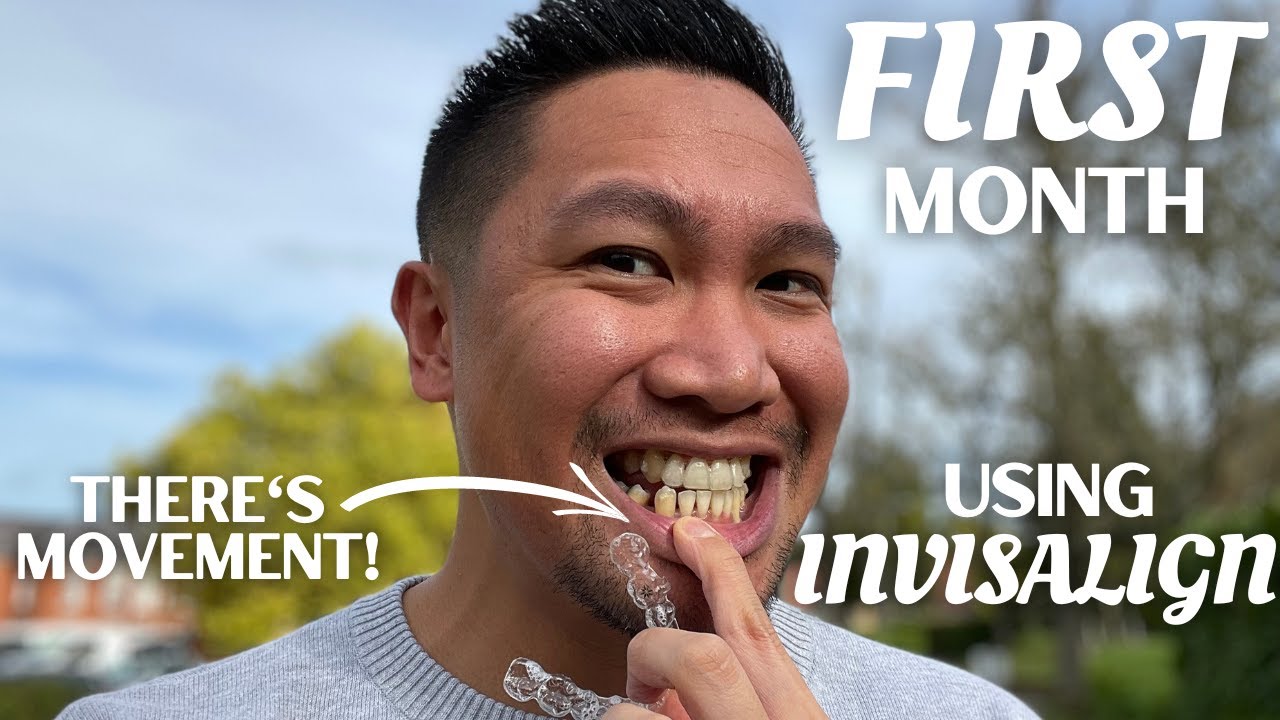 MY FIRST MONTH WITH INVISALIGN | Invisalign Journal