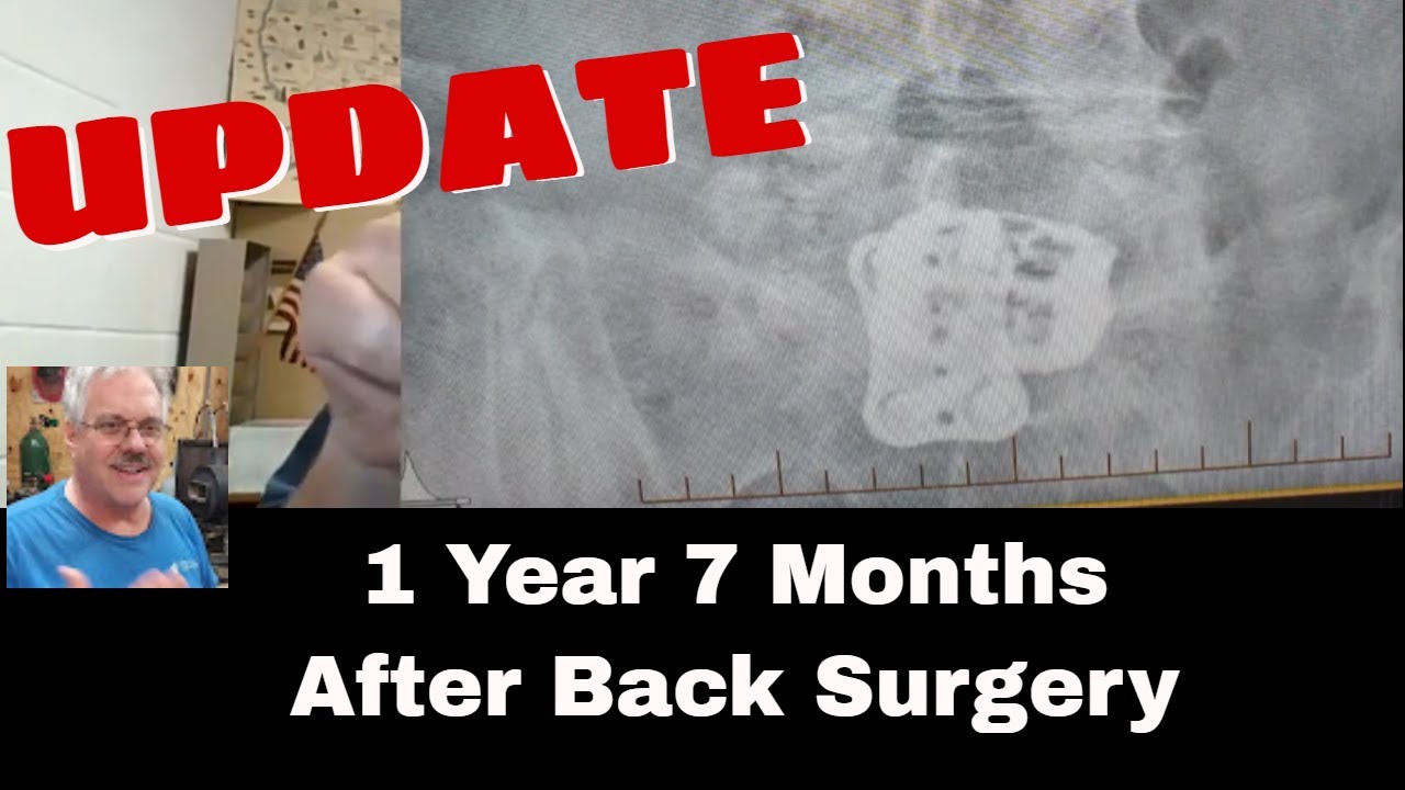 ALIF Back Surgery Follow Up - 1 year 7 months later