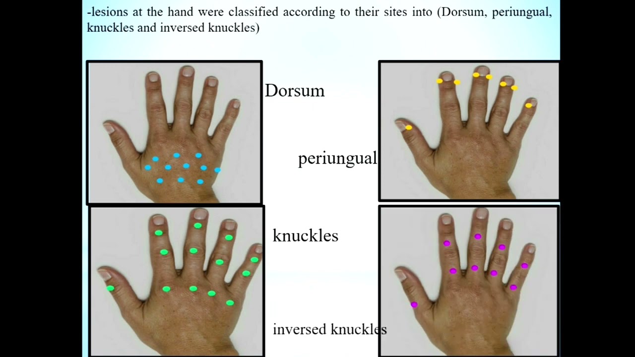 The Efficacy of PRP in Management of Acral Vitiligo