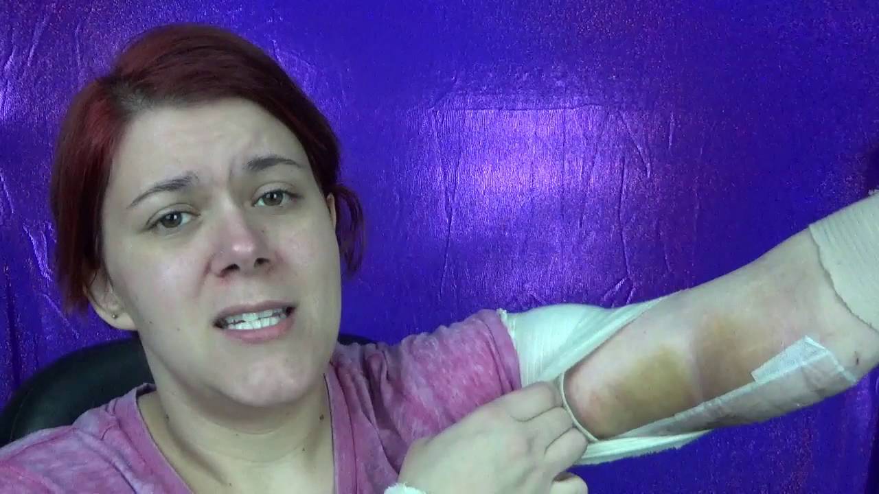 11 days post Brachioplasty