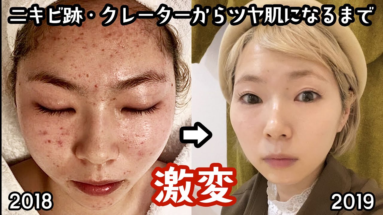 地獄の肌荒れからニキビ完治出来た方法を話します。