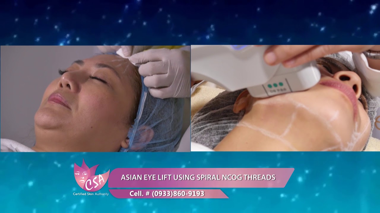 ASIAN EYE LIFT USING SPIRAL NCOG THREADS