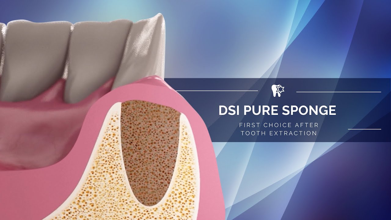 How to prevent a dry socket and bone loss after tooth extraction?