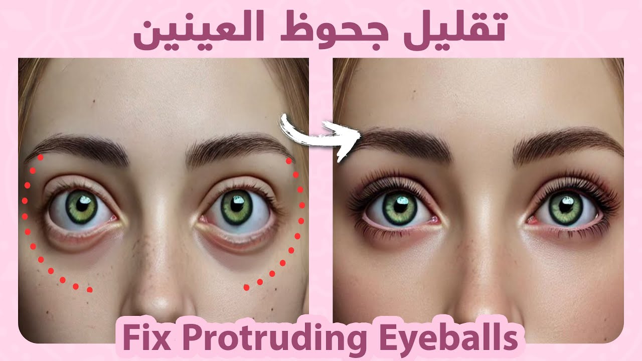 Fix Protruding Eyeballs Naturally | تقليل جحوظ العينين طبيعياً