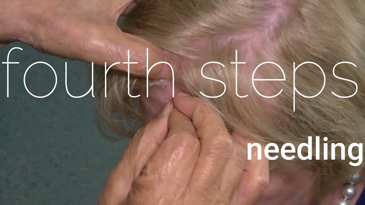 DEMO YNSA Yamamoto New Scalp Acupuncture Oskar Ausserer ZDN