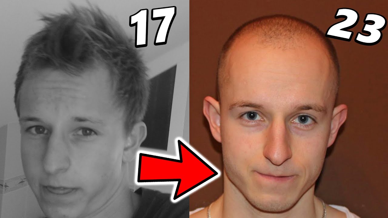 Considering a Hair Transplant at 18-24? Know This!