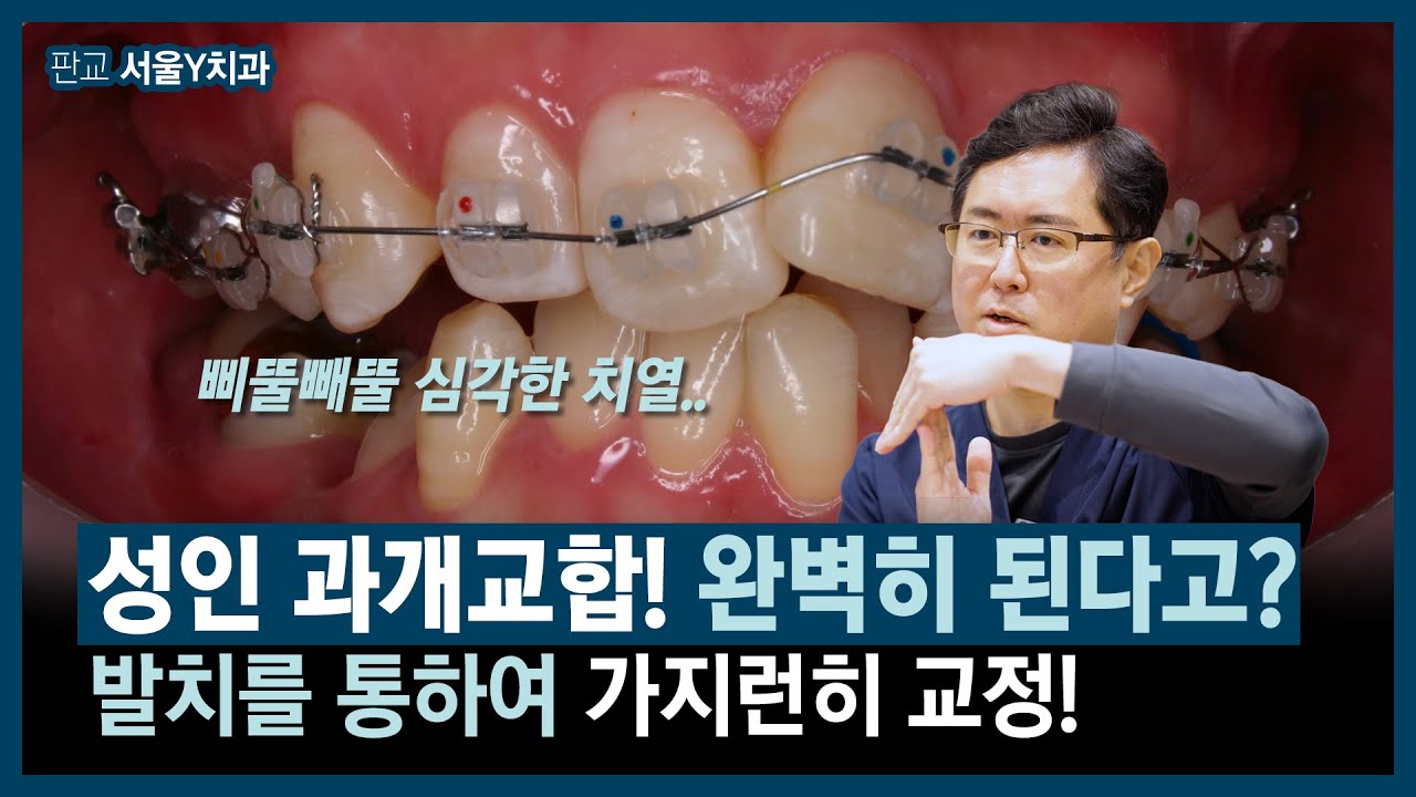 성인 과개교합, 왜 사람마다 치료가 다를까? 실제 사례 공개