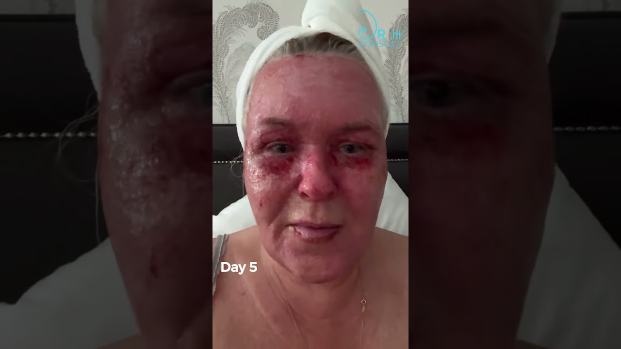 Donna’s Real CO₂ Laser Recovery | Fully Ablative CO₂ with Dr H. Day 1 to week 5