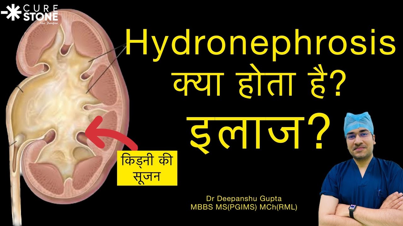 Hydronephrosis Treatment in Hindi? क्या होता है kidney की सूज़न (HYDRONEPHROSIS) |Dr Deepanshu Gupta