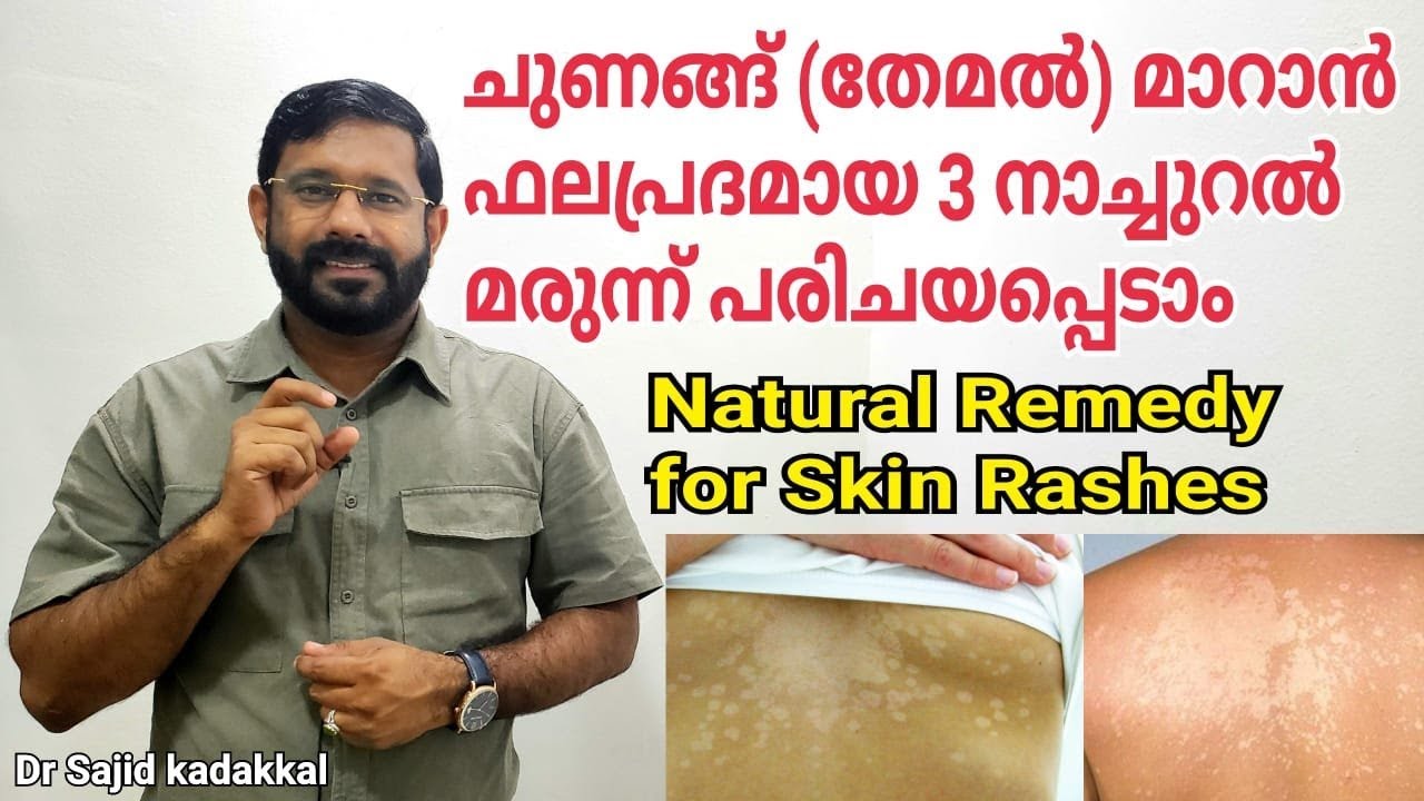 ചുണങ്ങ് (തേമൽ) മാറാൻ വളരെ ഫലപ്രദമായ 3 നാച്ചുറൽ റെമഡി
