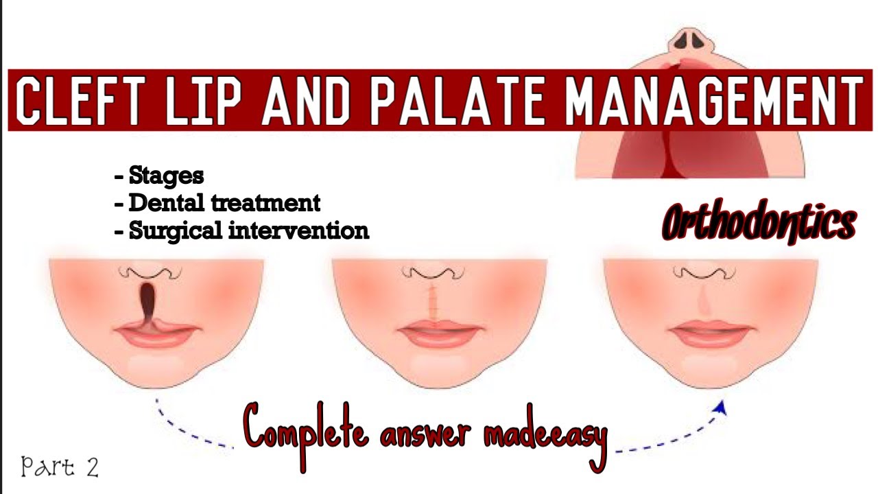 CLEFT LIP AND PALATE || MANAGEMENT || Part 2
