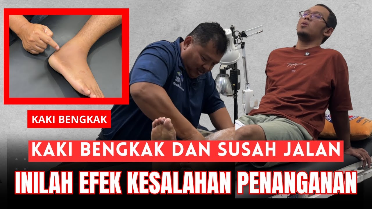 KAKI BENGKAK DAN SUSAH JALAN, INILAH EFEK KESALAHAN PENANGANAN - MCO ARIF