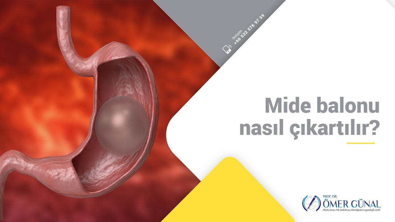 Mide balonu nasıl çıkarılır? I Prof  Dr  Ömer Günal