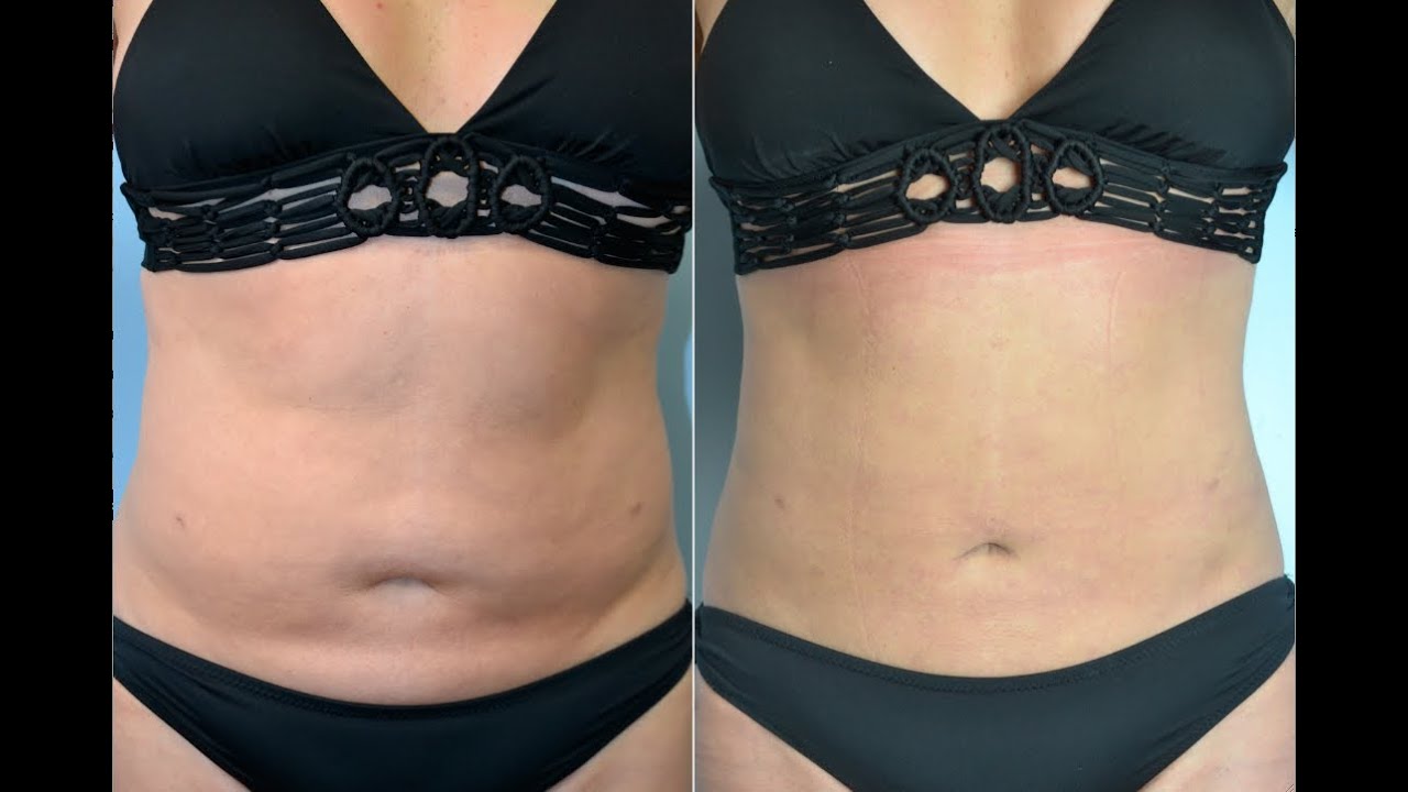 Liposuction Repair and Revision