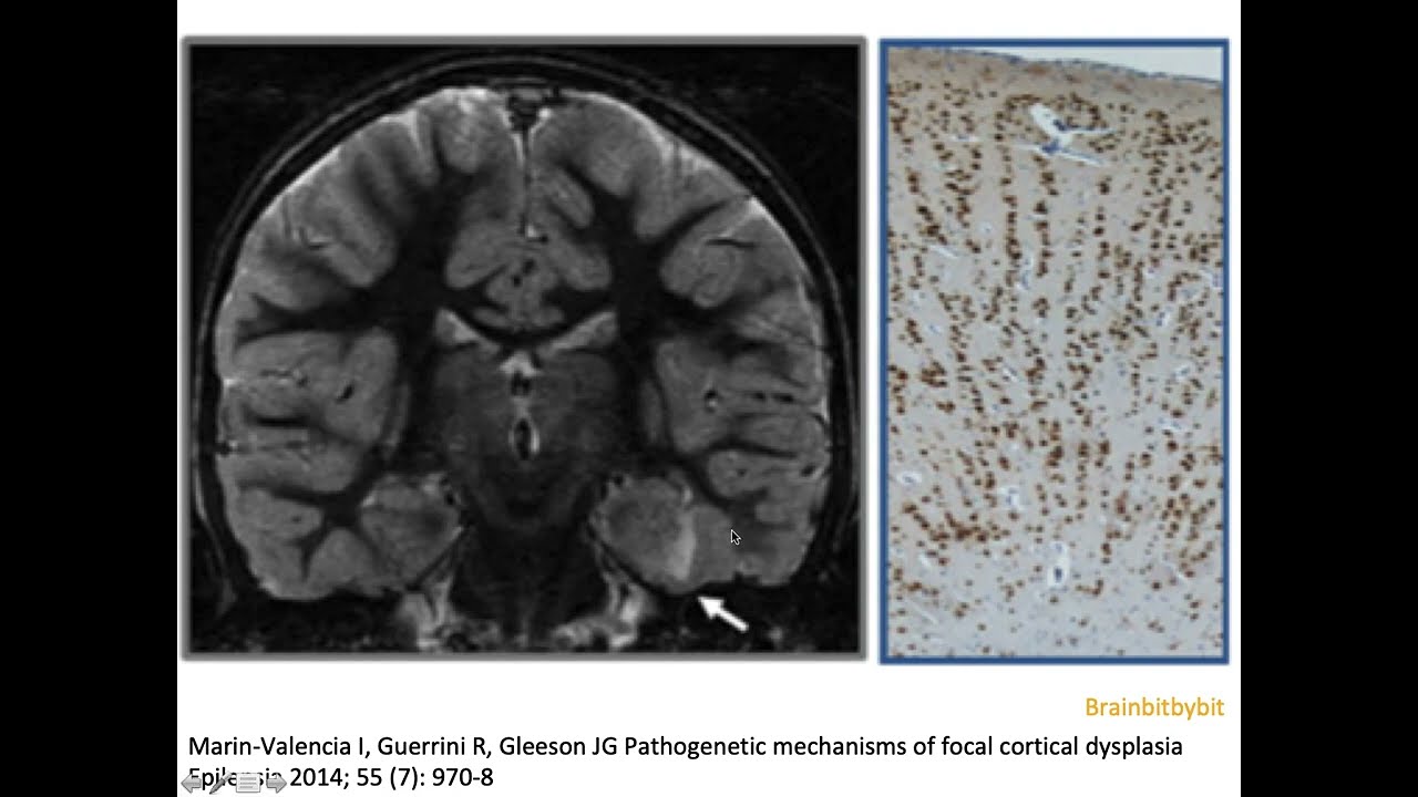 4. Focal cortical dysplasia I; FCD, dyslamination, cortical malformation, epilepsy, normal MRI
