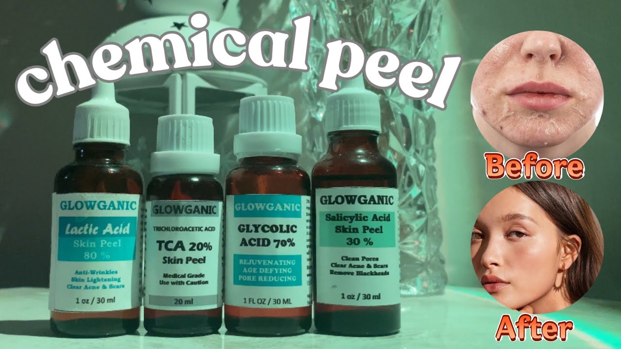 Chemical Peel At Home || Chemical Peel Treatment || skin peeling