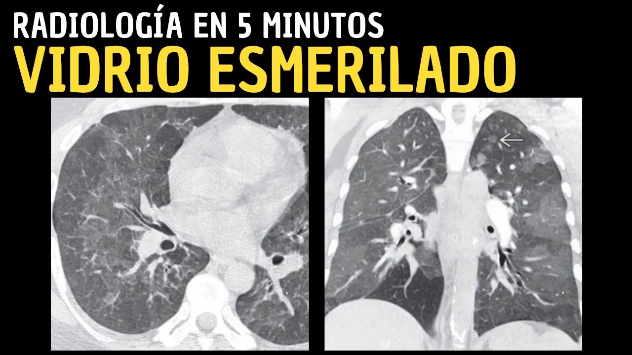 Signos radiológicos pulmonares: Vidrio esmerilado: Radiología en 5 minutos.