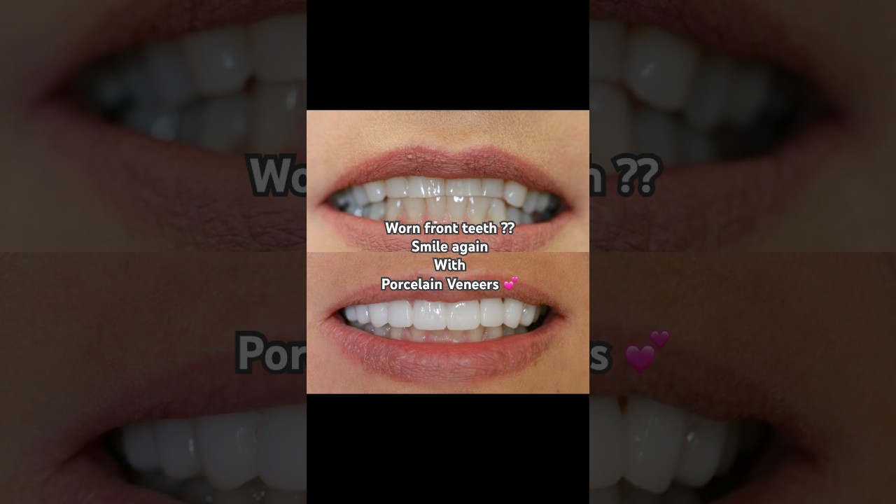 From Worn Down Teeth to Wow: Full Porcelain Smile Transformation 😁✨”