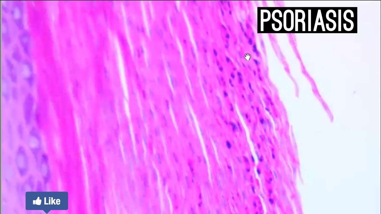 Psoriasis