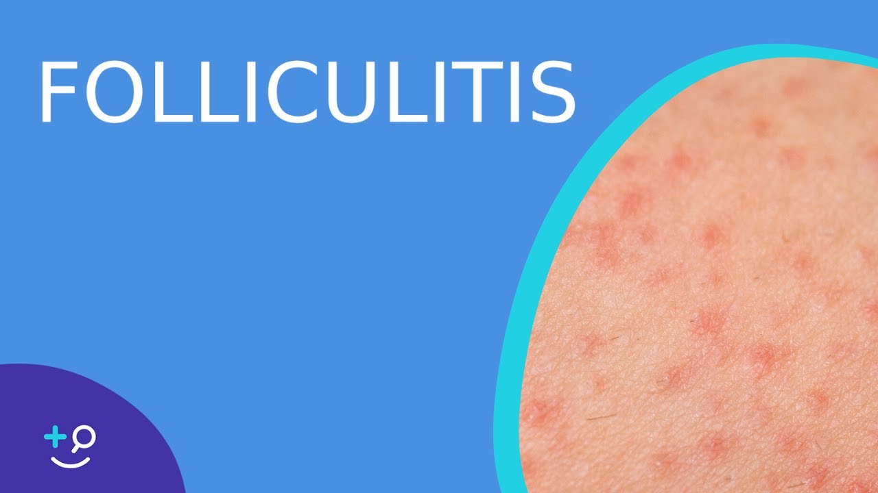 Folliculitis - Daily Do's of Dermatology