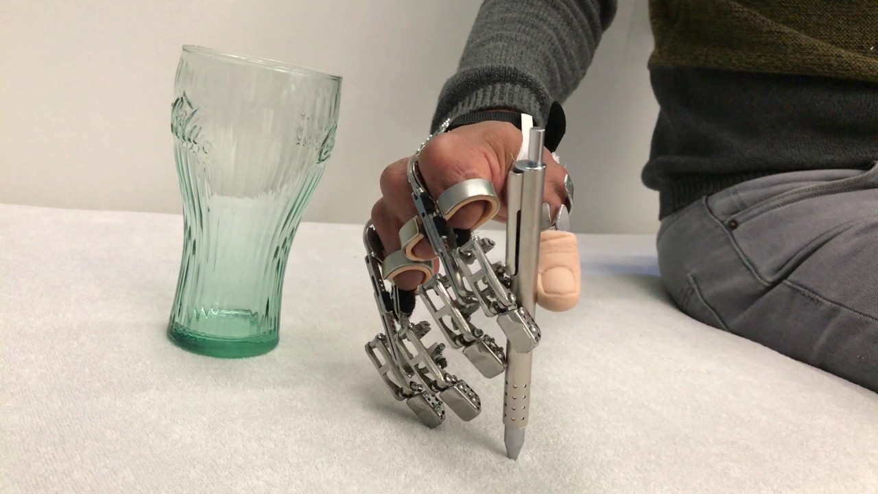Mechanische Eigenkraftprothese nach Verlust aller Finger
