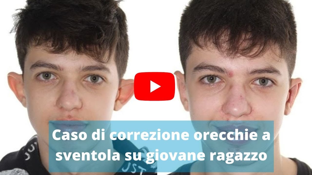 Caso di Otoplastica per correzione orecchie a sventola | dr. Enrico Dondè