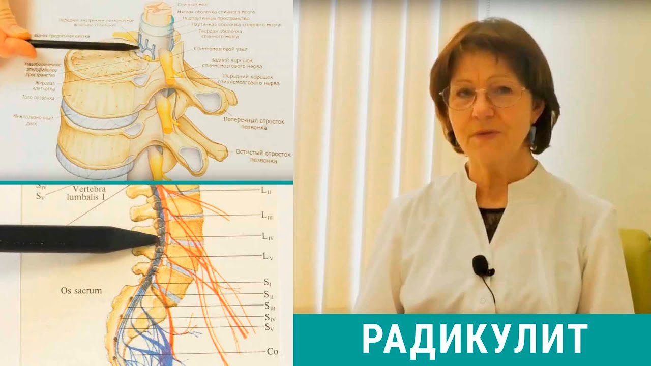 Радикулит: симптомы и лечение 