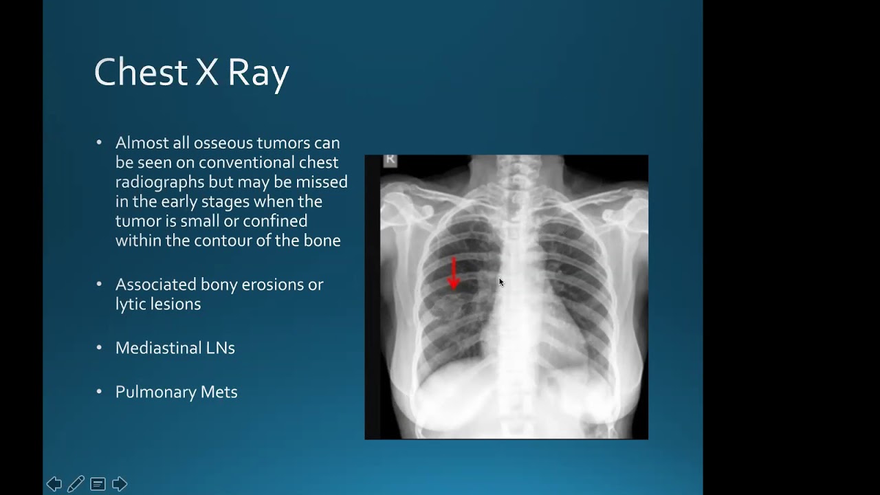 Chest wall tumours: Dr. Harish Mithran, Singapore