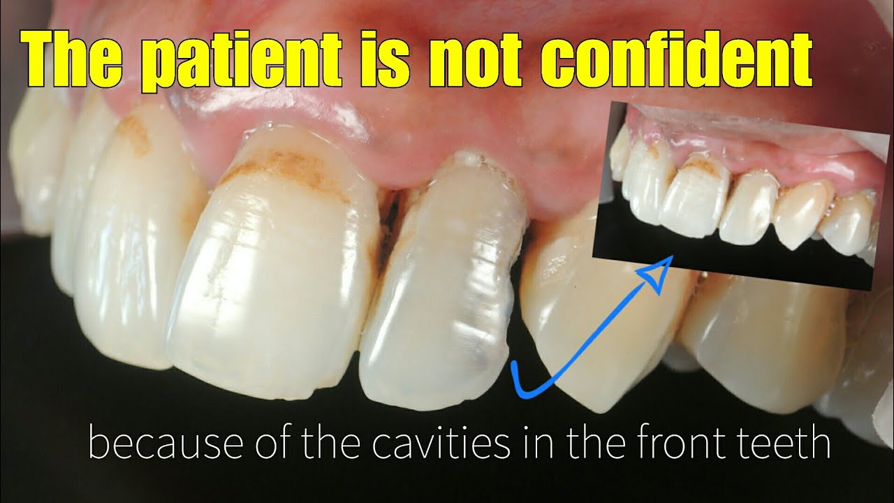 Tooth filling : Bring back his confidence