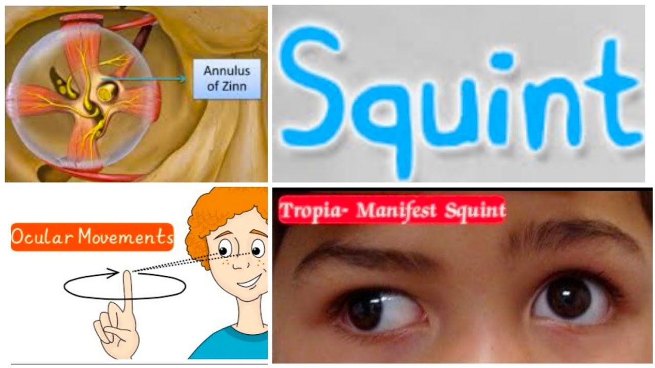 SQUINT 5| Manifest Non Paralytic Squint