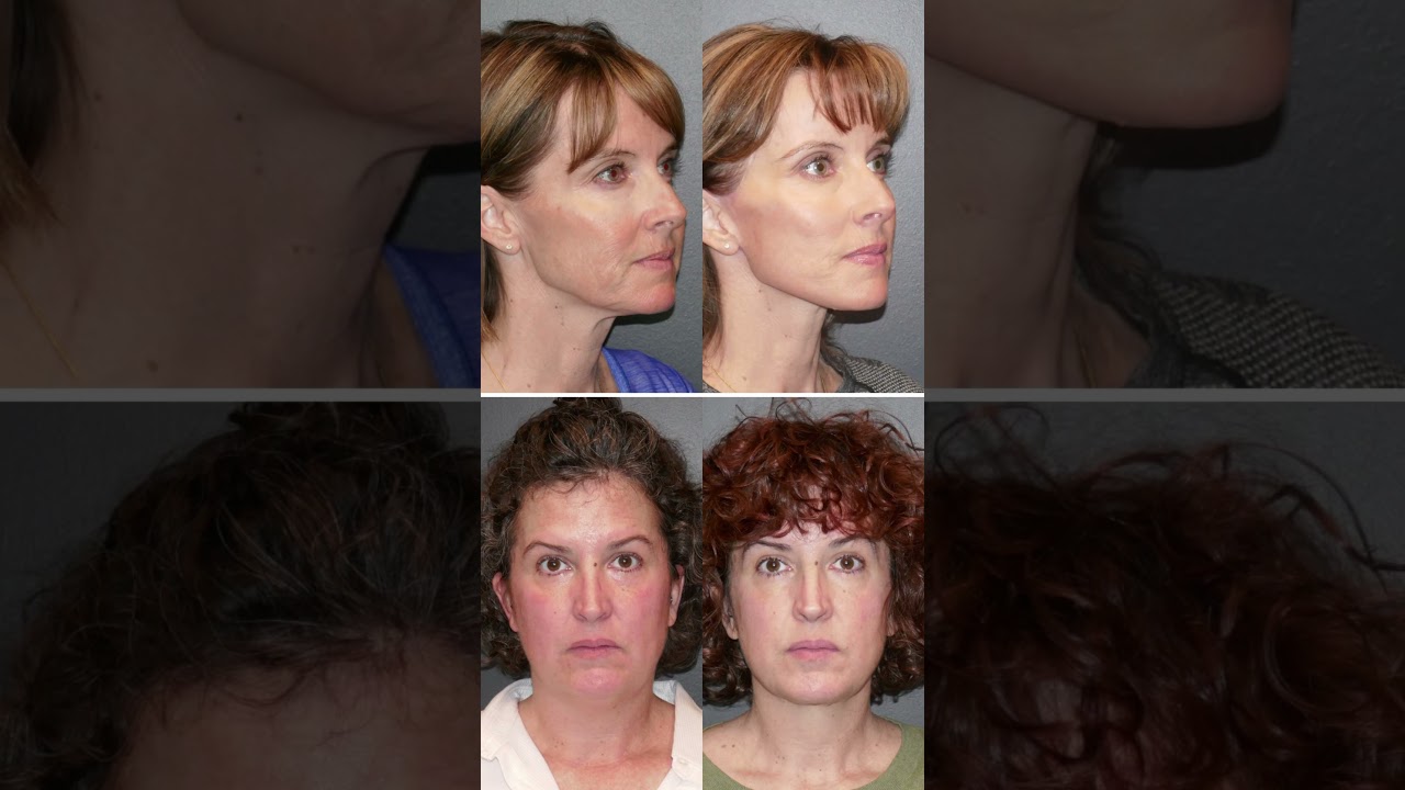 Denver Plastic Surgeons Recent Before and Afters