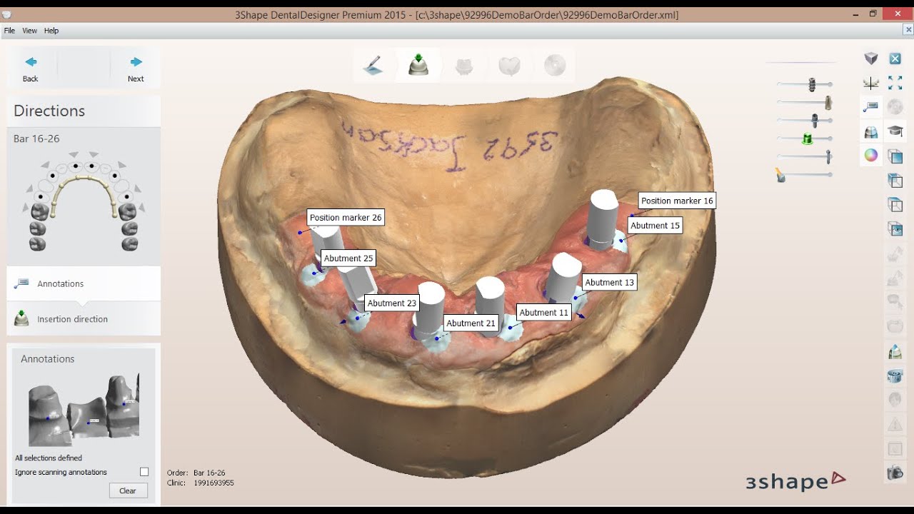 How to create an Implant Bar Order in 3Shape Dental System 2015