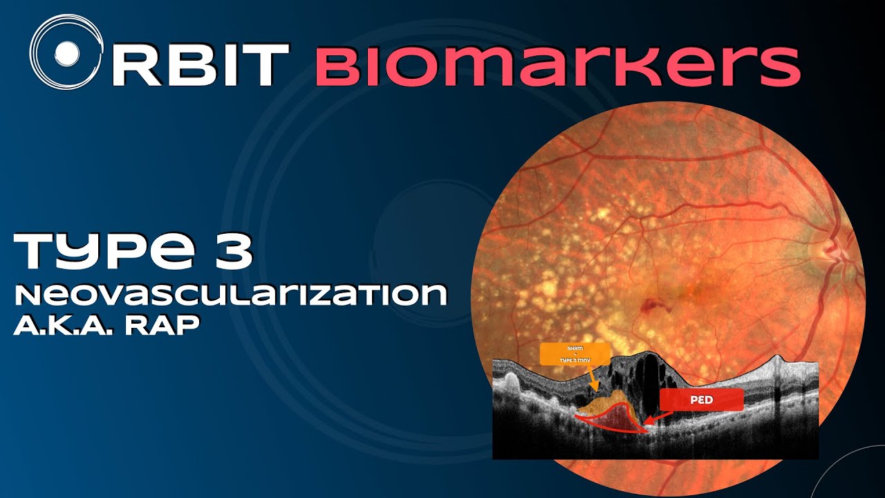 Type 3 macular neovascularization - OCT Biomarkers