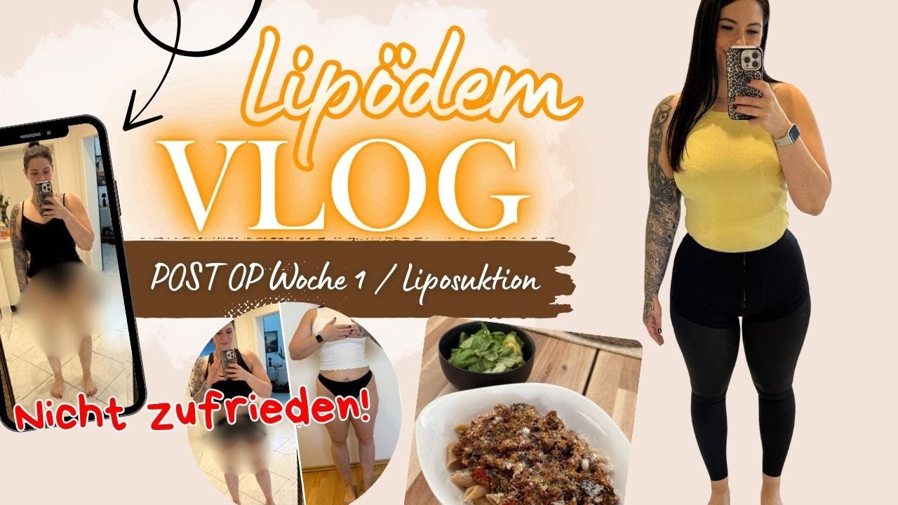 Liposuktion bei Lipödem mit Laser-Lipo Post OP Woche 1